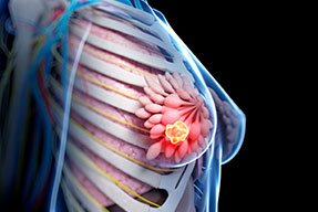 Cáncer de mama. Actualización y tendencias futuras